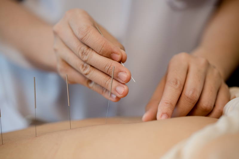 medycyna niekonwencjonalna - akupunktura